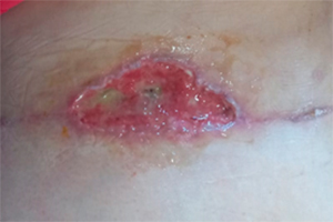 Deiscência de sutura